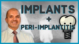 Learn Implants in 10 minutes - What Every Dentist Should Know