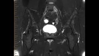 Bilateral trochanteric bursitis