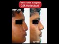 free nose surgery rhinoplasty gsr hospital hyderabad india मुफ़्त सर्जरी ఉచిత శస్త్రచికిత్స