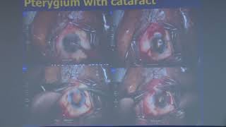 AIOC2023   GP120 topic Dr Kavita Rao   Optimising Cataract surgery outcomes in the Abnormal Cornea