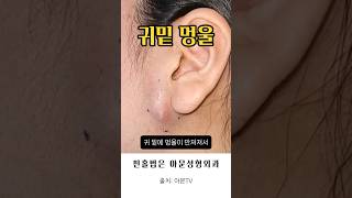 귀밑 멍울, 염증주사 후 커짐 (핀홀법 얼굴 피지낭종 표피낭종 수술 피부과 성형외과 병원 epidermal cyst surgery hospital seoul korea)[아문TV]