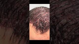 Hairline design is one of the most important parts of hair transplantation.