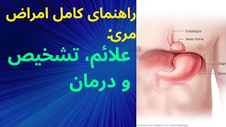 فتق هیاتال: علائم، تشخیص و درمان