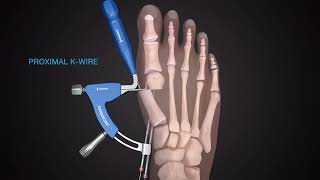 Minimally-Invasive Bunion Correction Surgery | Kansas City Direct Care Podiatrist
