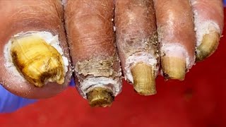 Toenails Are As Thick As Bricks  Trim Them Thoroughly [Dr. Liu's Pedicur]