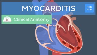 Myocarditis: Causes, symptoms, diagnosis, treatment and prognosis | Kenhub