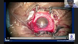 Update Series on CORNEA - Dr.Shreyas Ramamurthy