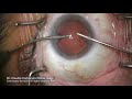 ISOPURE IOL implantation with R-Evo Smart - Dr. Claudio Carbonara (2)