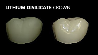 Porcelain Veneer, Crown and Bridge Polishing