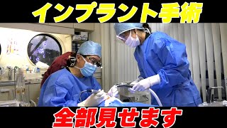 インプラント手術全部見せます