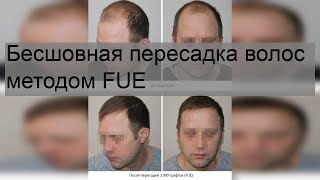 Бесшовная пересадка волос методом FUE