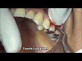 Failed root canal premolar extraction