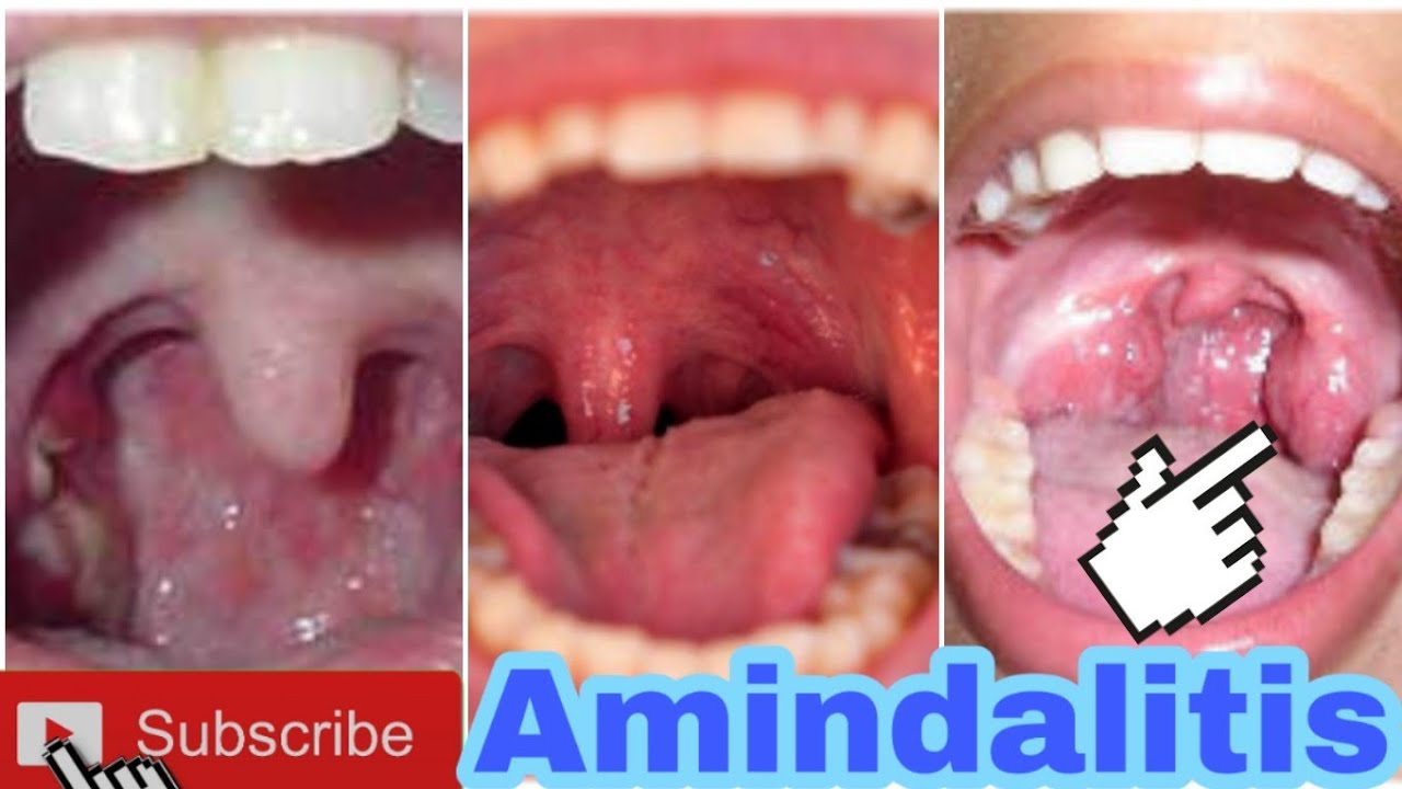 Así Se Cura La Amigdalitis O Infección En La Garganta - YouTube