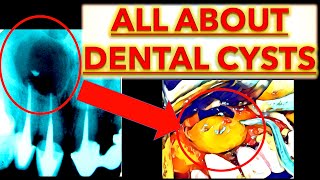 EASY: ALL Odontogenic Cysts!! TUTORIAL: OKC, Radicular, Dentigerous, Periapical Cyst Dental CBCT OPG