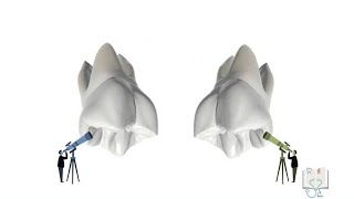 Differences between Maxillary 1st & 2nd Molar