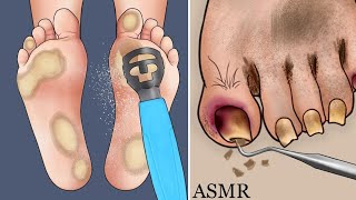 ASMR ingrown toenail removal | asmr foot toenail removal animation