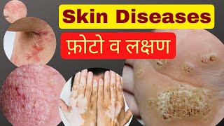 त्वचा रोग ( Skin diseases )-लक्षण व चित्र | skin disease picture with name | skin diseases symptoms