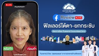 รีวิวจากคนไข้จริง - คุณจุ๊ย กับการฉีดฟิลเลอร์ใต้ตา-ยกกระชับ โดยคุณหมอเมฆ อาจารย์แพทย์ด้านฟิลเลอร์