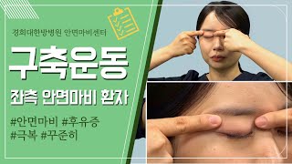 [경희대한방병원] 안면마비 후유증 극복! 구축(좌측 안면 마비 환자)