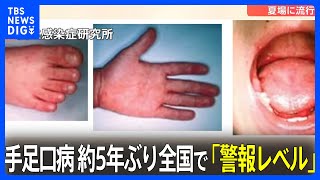 手足口病の患者数が全国で「警報レベル」 13週連続で増加｜TBS NEWS DIG