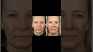 Maxyfill : Achieve Radiant and Healthy Skin #SkinCareTransformation #FacialRejuvenation