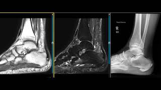 Common findings in 73 year old with heel pain