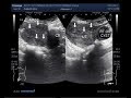 Ultrasound Video showing multiple masses in the uterus & Ovarian cyst.