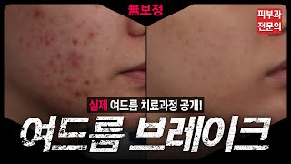 Overcome severe acne! Actual acne treatment process revealed!