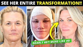 Facelift at Nearly 60 Changes Her Entire Life! Dramatic Vertical Restore Surgery Before/After!