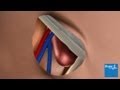 How open femoral hernia surgery is carried out | Bupa Health