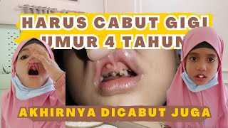 cabut gigi susu pertama umur 4 tahun #cabutgigi #cabutgigisusu #gusibernanah