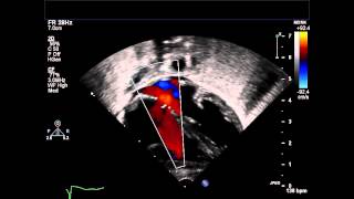 Fenestrated Secundum Atrial Septal Defect Subcostal Coronal Color Doppler