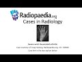 Severe wrist rheumatoid arthritis (Radiopaedia.org) Cases in Radiology