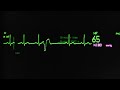 ventricular extrasystoles with r on t phenomenon on an ecg monitor