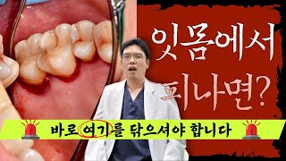 잇몸에서 피나면 여기를 닦아주셔야 합니다.(잇몸염증 대처법)