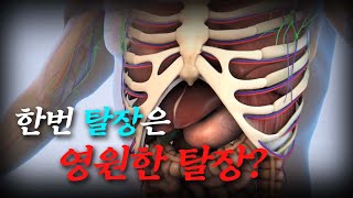 삶의 질을 떨어뜨리는 탈장ㅣ건강플러스 | 08월 13일