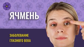 Ячмень глаза