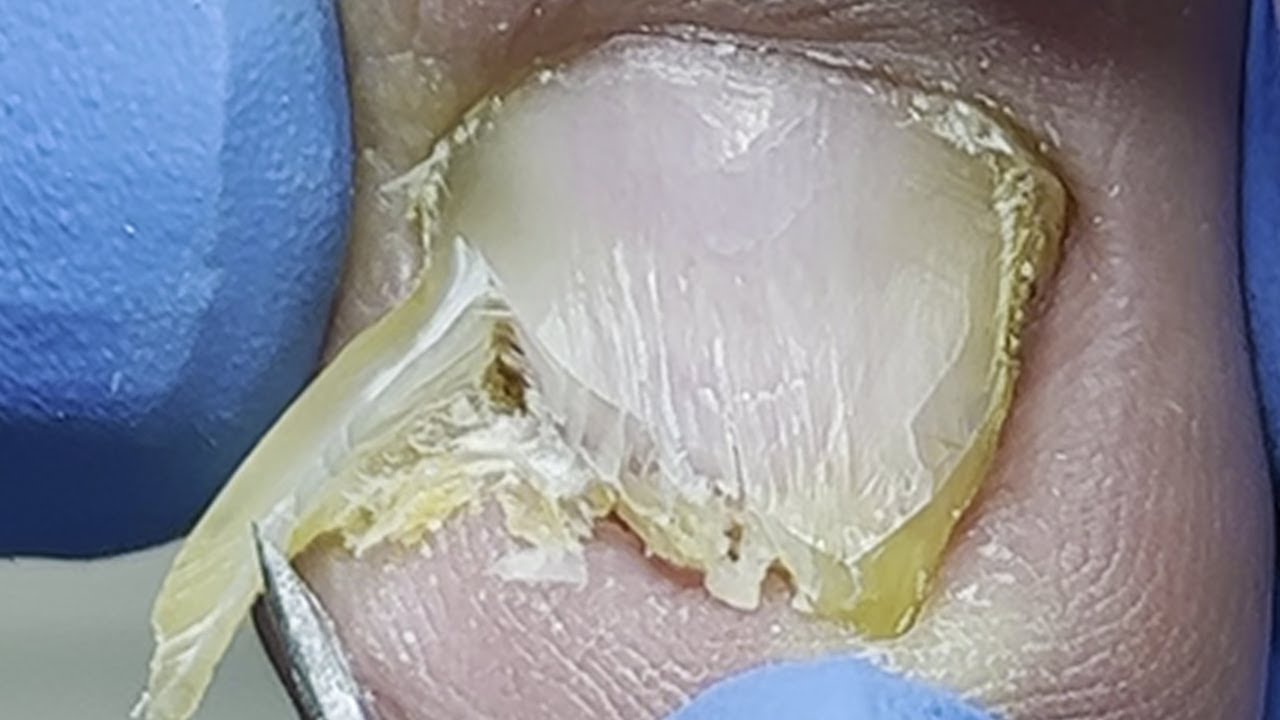 Nail fungus trimming~【Xue Yidao Pedicure】