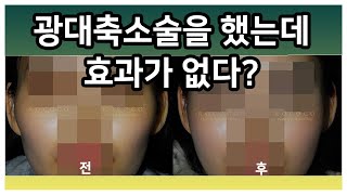 광대축소술을 했는데 효과가 없다? feat.전후사진 #얼굴형 #퀵광대 #변형15분광대