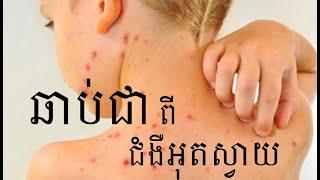 វិធីឆាប់ជាពីជំងឺអុតស្វាយ - Get better faster, chickenpox