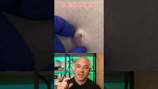 Doctor reacts to MASSIVE cyst! #dermreacts #doctorreacts #pimplepop #cystpop