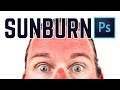 How to Get Rid of Sunburn (almost) Instantly! (PHOTOSHOP) How to Get Rid of Sunburn (almost) Instantly! (PHOTOSHOP)