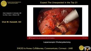 Expect the unexpected: Laparoscopic cholecystectomy