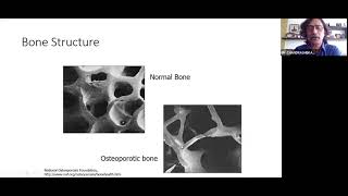 Patient awareness Talk on Osteoporosis in view of National Bone and Joint Week (English)