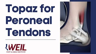 Topaz for Peroneal Tendons | Weil Foot \u0026 Ankle Institute