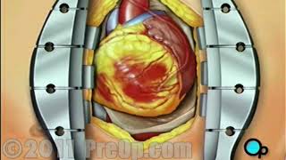 Heart -Coronary Artery Bypass Graft (CABG off-pump) PreOp® Patient Education HD
