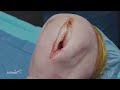 Treatment of a Medial Femoral Condyle Osteochondral Defect Using an Osteochondral Allograft