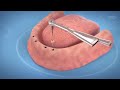 Dental Implants for a Toothless Jaw (3D medical animation)