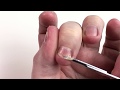 Satisfying Nail Clipping - Clipping off my nasty fungus-infected fingernails!