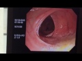 大腸內灌注益生菌 intracolonic instillation of probiotics 的實際狀況。